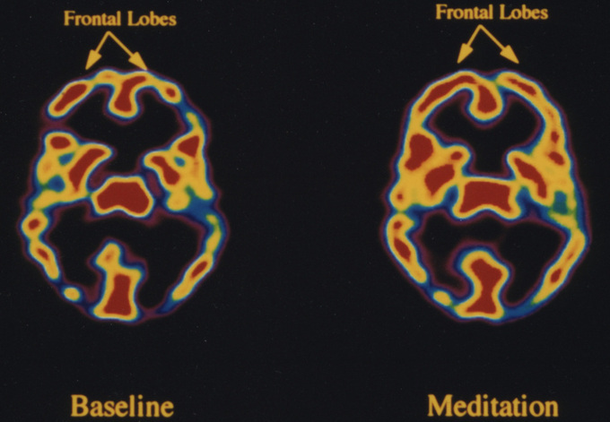 Cambios percibidos en el cerebro en estado de meditación. Fuente: Andrew Newberg.