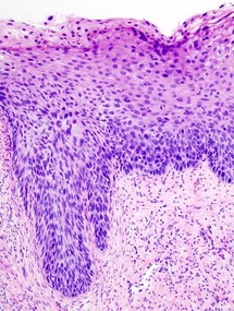 Neoplasia cervical pre-maligna en cuello uterino. Fuente: Wikimedia Commons.