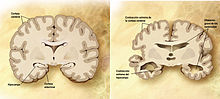 Comparación entre un cerebro normal y un cerebro afectado de Alzheimer. Fuente: Wikimedia Commons.