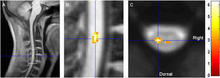 El trabajo analiza la respuesta al dolor mediante resonancias magnéticas de la medula espinal. Imagen: Sprenger et al. Current Biology.