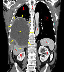 Un TAC coronal mostrando un cáncer en la cavidad pulmonar. Fuente: Wikimedia Commons.