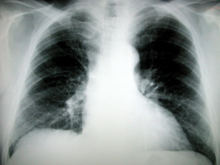 Las "vacunas pulmonares" son un campo prometedor. Fuente: MorgueFile.