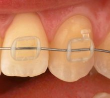 Brackets transparentes. Fuente: UC3M.