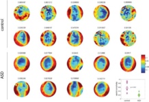 Imágenes de la actividad cerebral de distintos niños, que permiten distinguir cuáles tienen autismo. Imagen: Luis García Domínguez, José Luis Pérez Velázquez, Roberto Fernández Galán. Fuente: PLos ONE/ScienceDaily.