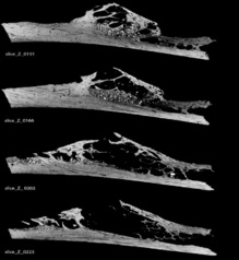 La costilla cancerosa encontrada en Croacia. Fuente: Penn Museum/SINC.