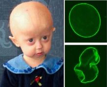 La progeria produce envejecimiento prematuro. Fuente: Wikipedia.