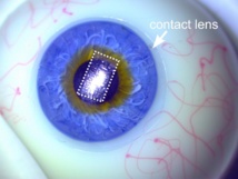 El dispositivo transparente se puede poner en una lente de contacto para medir la presión intraocular en enfermos con glaucoma. Imagen: Salvatore et al. Fuente: SINC.