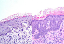 Epidermis humana transplantada en ratón con signos de psoriasis (izquierda) y sin alteraciones cuando se trata con bloqueantes del microRNA miR-21 (derecha). Fuente: CNIO/SINC.