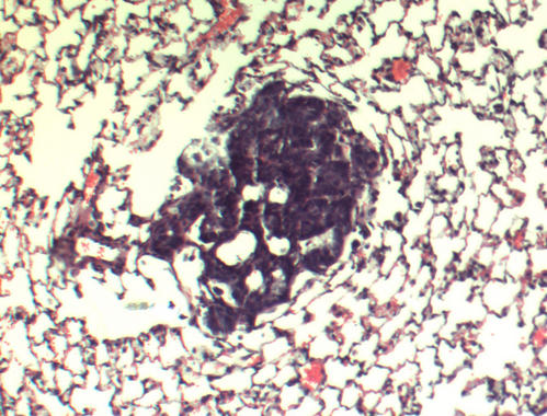 Pulmón con abundante 27HC: sección de pulmón con un nódulo metastásico (mancha oscura en el centro). Fuente: Duke Medicine.