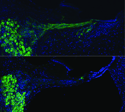 Comparación del nervio coclear tras la terapia génica de neurotrofina (arriba), frente a la cóclea sin tratar del mismo animal (abajo). Fuente: UNSW.