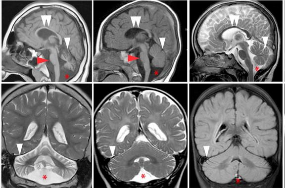 Imagen por resonancia magnética de cerebros de pacientes de las familias afectadas por la mutación. Las flechas señalan zonas donde se perciben atrofias. Fuente: Cell.