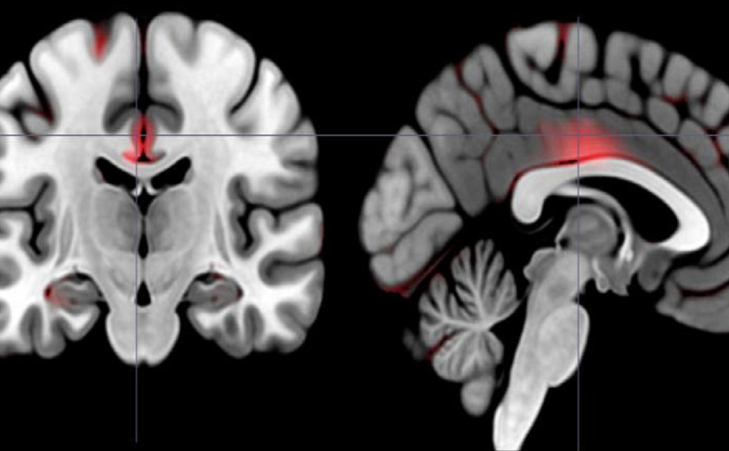 Las áreas marcadas en rojo reflejan mayores cantidades de materia gris en personas extrovertidas "dinámicas". Imagen: Laboratorio White. Fuente: Universidad de Brown.