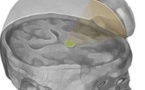 Reactivan el cerebro de un hombre en coma usando ultrasonidos