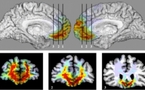 Determinan el área del cerebro que crea los juicios morales