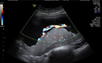 Anomalías de la placenta pueden indicar riesgo de autismo en recién nacidos