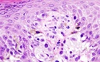 Detectan el melanoma por el olor de sus células