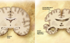 Identifican once genes relacionados con el Alzheimer en un estudio a gran escala