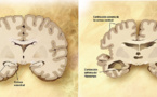 Posible relación del Alzhéimer con las infecciones por hongos