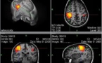 La psicoterapia normaliza la actividad del sistema límbico del cerebro